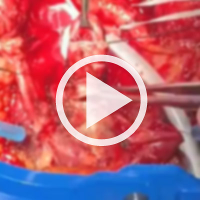 Pulmonary artery stenosis